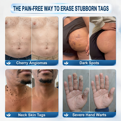 Coredew®👩‍⚕️ 𝟕-𝐃𝒂𝘆 𝐒𝗸𝐢𝐧 𝐓𝒂𝗴 & 𝐒𝐩𝙤𝐭 𝐄𝐫𝒂𝐬𝙚𝐫 Painless & Scar-Free Advanced Imperfection Removal Rollerball Pen