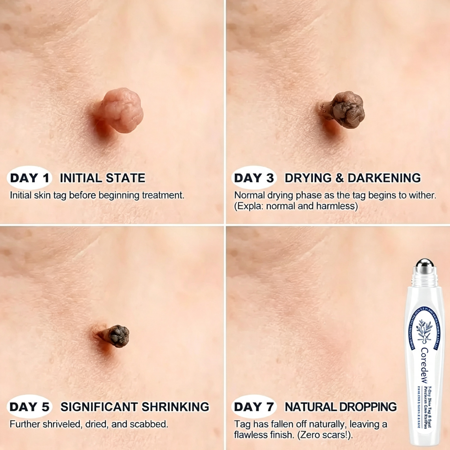Coredew®👩‍⚕️ 𝟕-𝐃𝒂𝘆 𝐒𝗸𝐢𝐧 𝐓𝒂𝗴 & 𝐒𝐩𝙤𝐭 𝐄𝐫𝒂𝐬𝙚𝐫 Painless & Scar-Free Advanced Imperfection Removal Rollerball Pen
